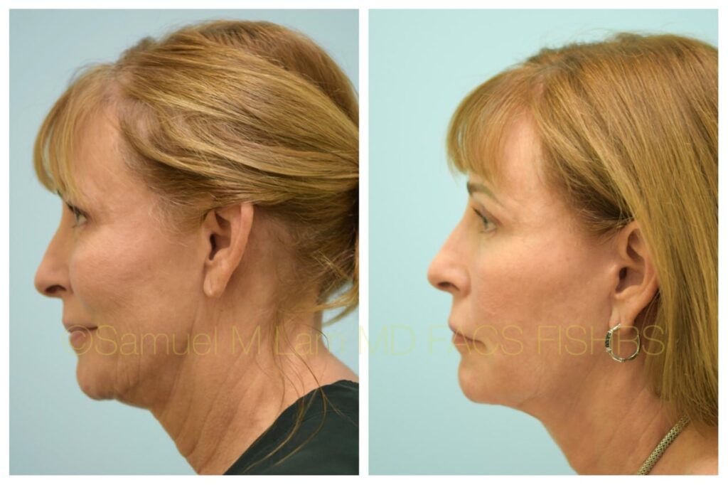 Dallas Facelift/Neck Lift Before and After Photos Plano Plastic