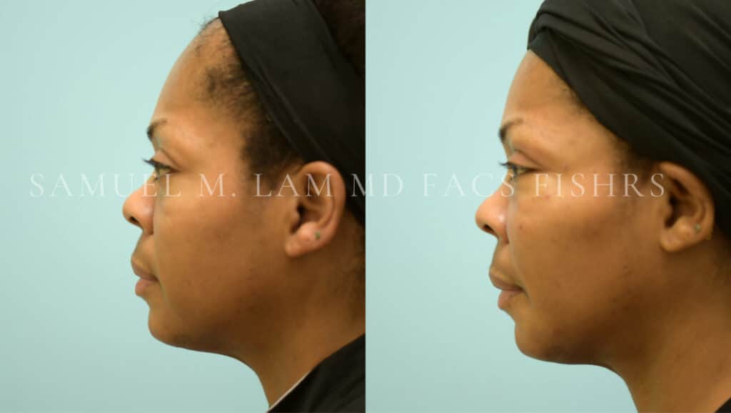Dallas Fat Grafting Before and After Photos Plano Plastic Surgery