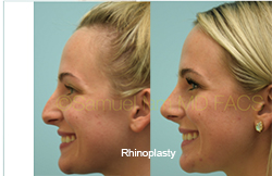 Rhinoplasty Before and After Plano, TX