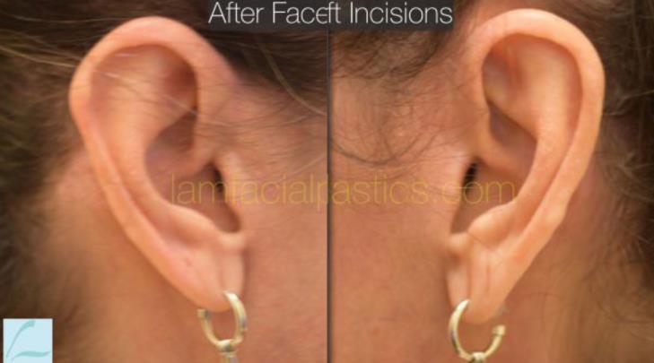 A woman who received a facelift in Garland, TX