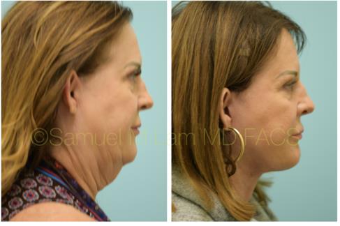 A woman who received a facelift in Garland, TX