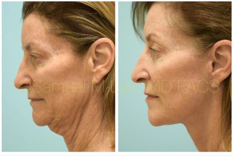 A woman who received a facelift in Garland, TX