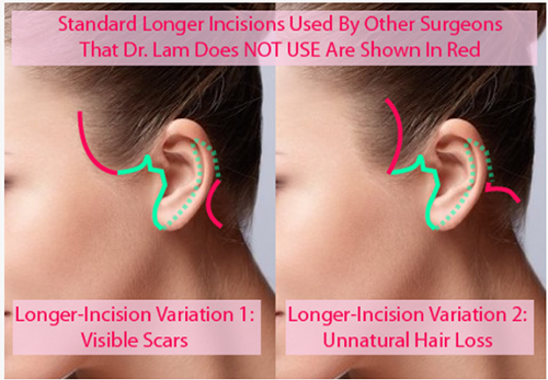 Longer Incision Variations
