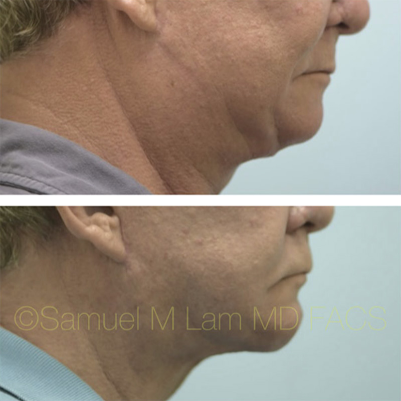 Facelift/Mini Facelift Before & After Photos Dallas and Plano, TX