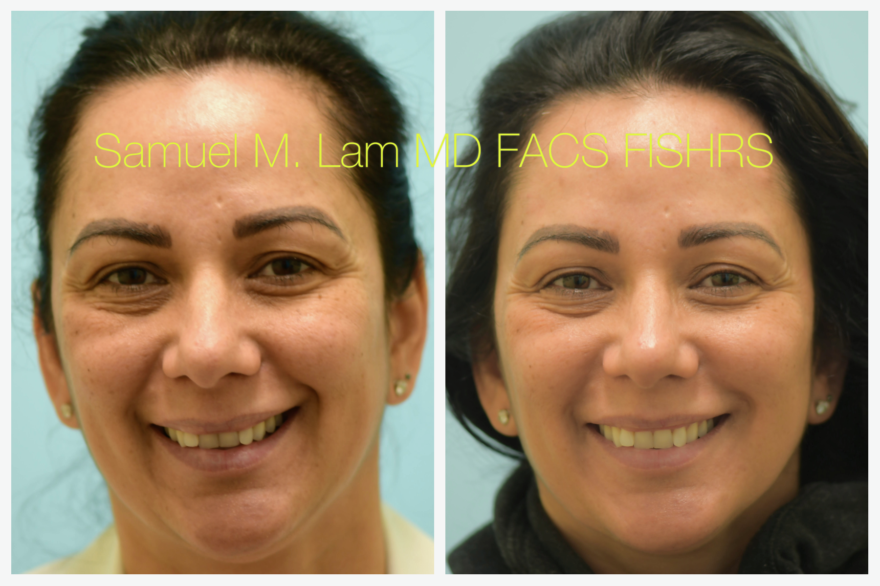 Injectable Fillers Before & After Dallas
