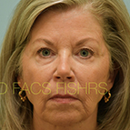 Image of a Facial Fat Grafting patient