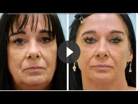 Dallas RF Microneedle, Botox, MesoBotox Testimonial to Correct Smoker’s Skin
