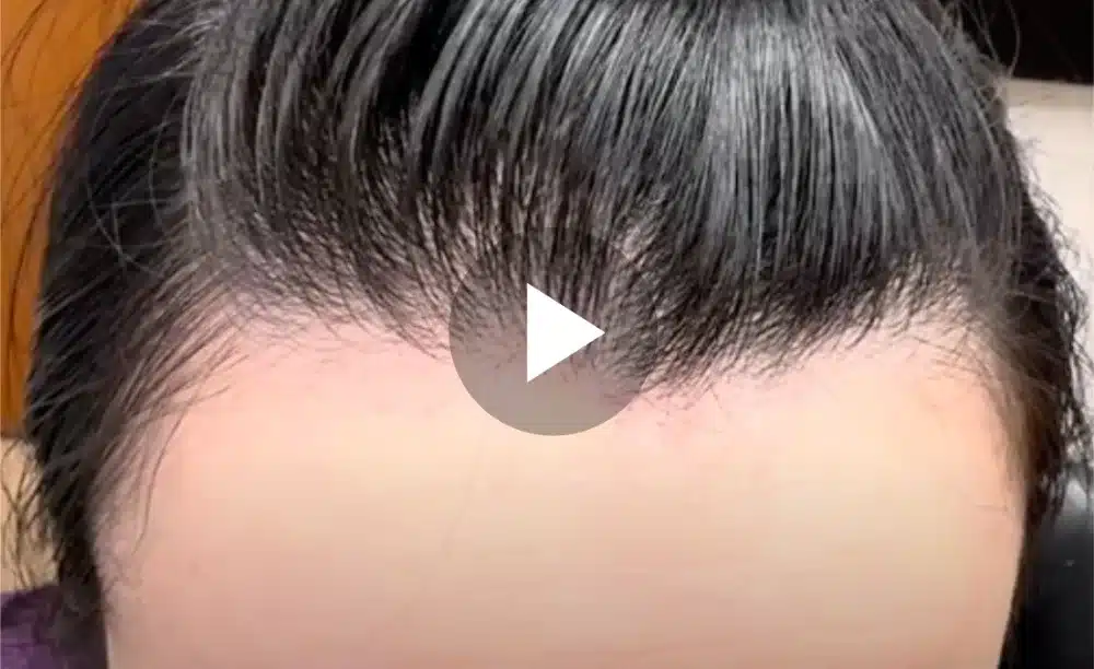 Osteoma Removal Video 4