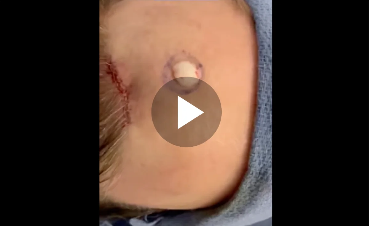 Osteoma Removal Video
