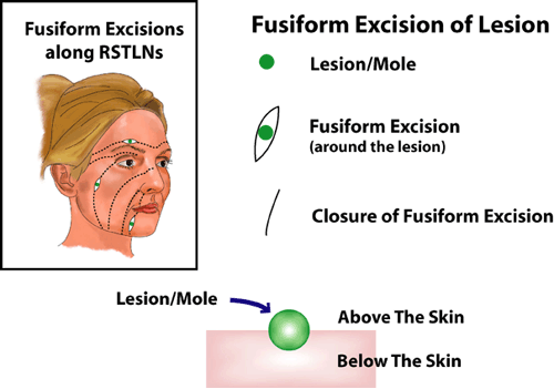 fusiform