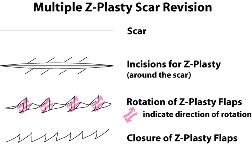 Scar Revision FAQs Dallas Facial Scar Reduction FAQ Plano Scar Revision FAQs Dallas Facial Scar Reduction FAQ Plano