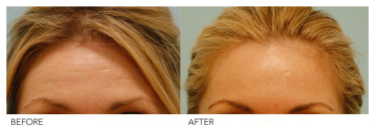 Botox First Time is the Most Important Time Lam Facial