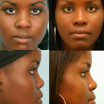 Rhinoplasty Before and After Plano, TX