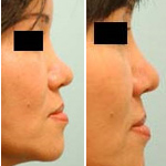 Rhinoplasty Before and After Plano, TX