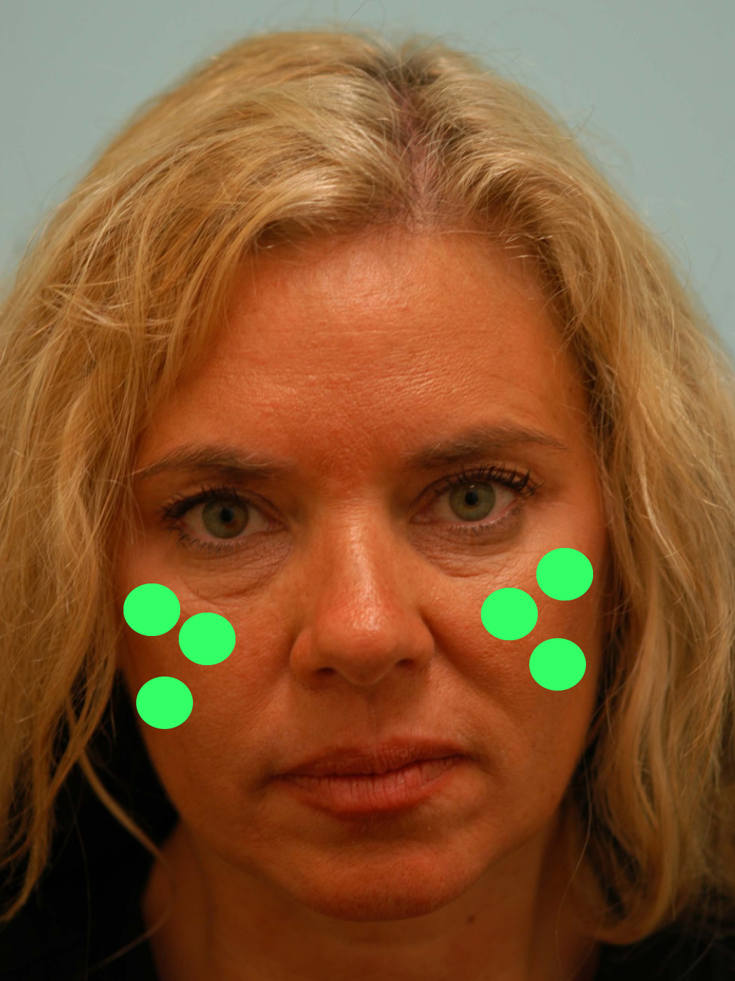Breaking down the Cheek into Aesthetic Subunits: Avoiding Chipmunk Cheeks | Lam Facial ...1036 x 1382