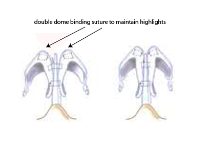 Double dome binding suture