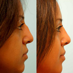 Rhinoplasty Before and After Plano, TX