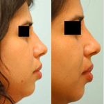 Rhinoplasty Before and After Plano, TX