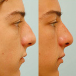 Rhinoplasty Before and After Plano, TX