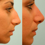 Rhinoplasty Before and After Plano, TX