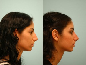 middle eastern rhinoplasty dallas