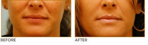 restylane