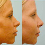 Rhinoplasty Before and After Plano, TX