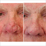 Rhinoplasty Before and After Plano, TX