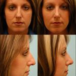 Rhinoplasty Before and After Plano, TX