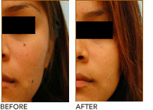 skin_lesions