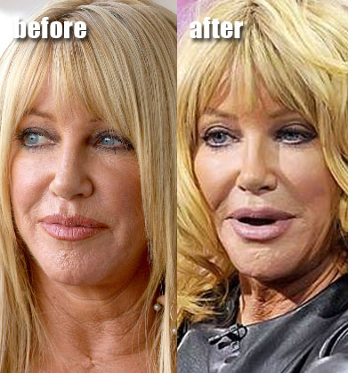 suzanne-somers-facial-fillers